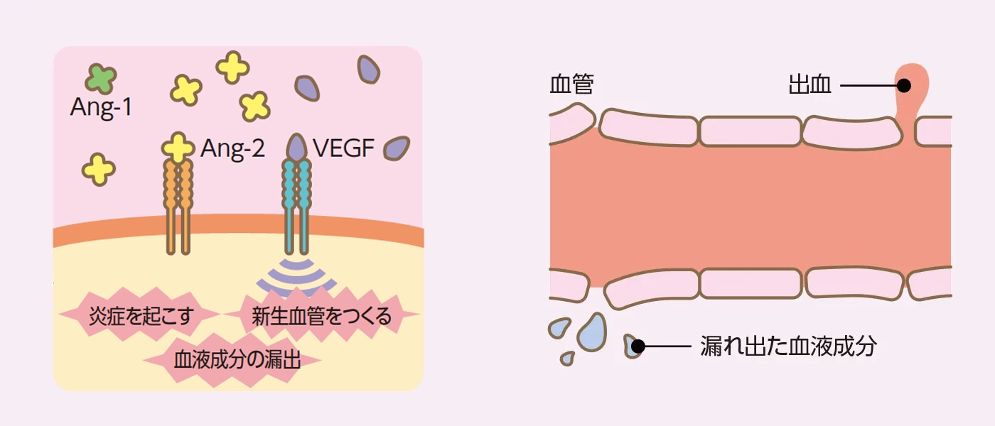 病気の網膜血管のイメージ図