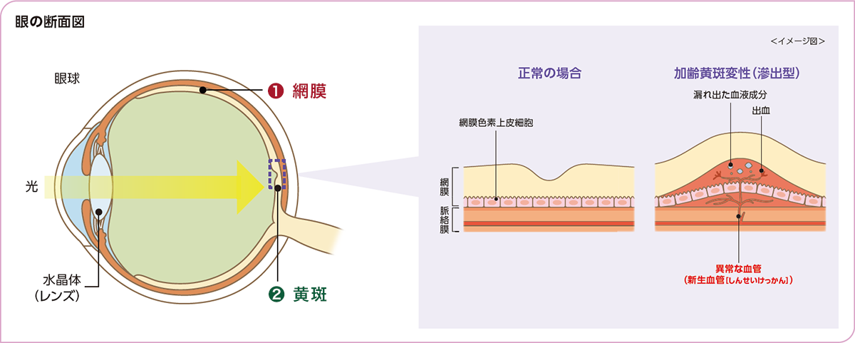 黄斑変性症と黄斑ジストロフィー