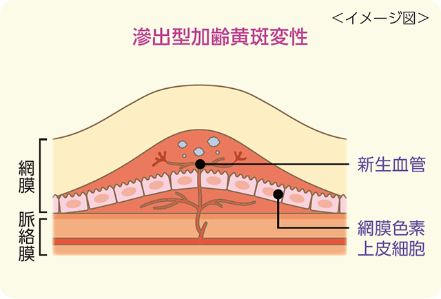 滲出型加齢黄斑変性のイメージ図：網膜、脈絡膜、新生血管、網膜色素上皮細胞