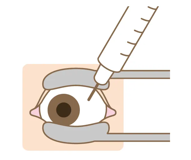 眼への薬剤注射のイラスト