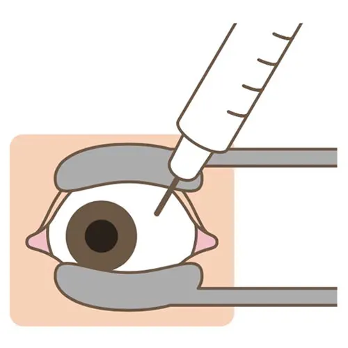 バビースモを白眼部分に注入するイメージ